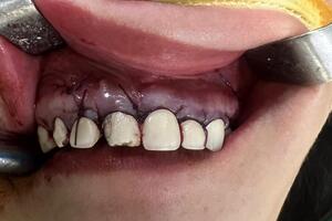Nang xương hàm do bọc răng thẩm mỹ